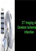 CT Imaging-of-cerebral-ischemia-and-infraction